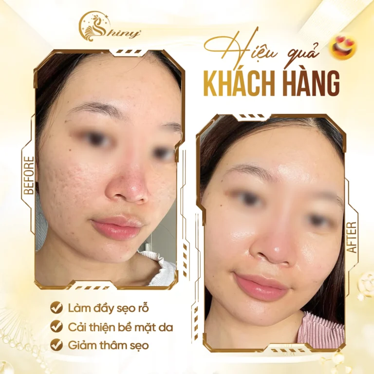 Phản hồi khách hàng sau liệu trình chăm sóc da tại Shiny Beauty Clinic