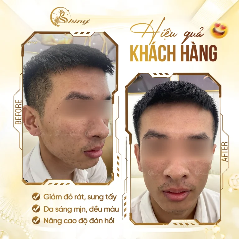 Hình ảnh thực tế chăm sóc da mụn tại Shiny Beauty Clinic