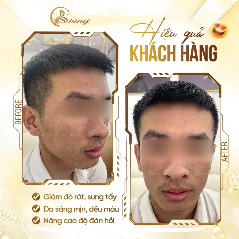 Theo dõi tình trạng da mụn qua từng giai đoạn tại Shiny Beauty Clinic