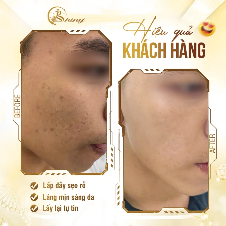 Phản hồi khách hàng về chăm sóc da thâm tại Shiny Beauty Clinic