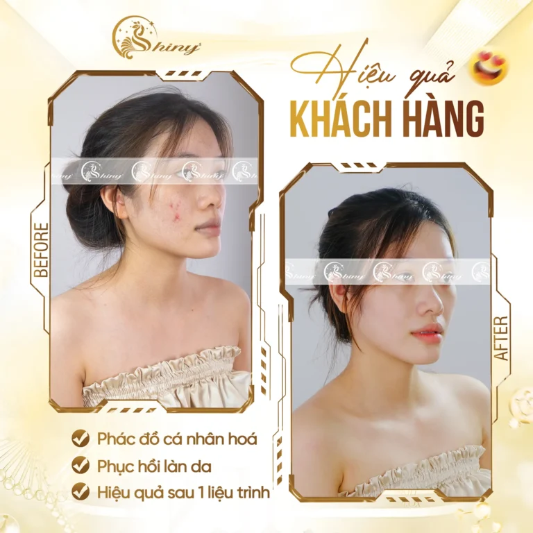 Hình ảnh chăm sóc da mụn tại Shiny Beauty Clinic