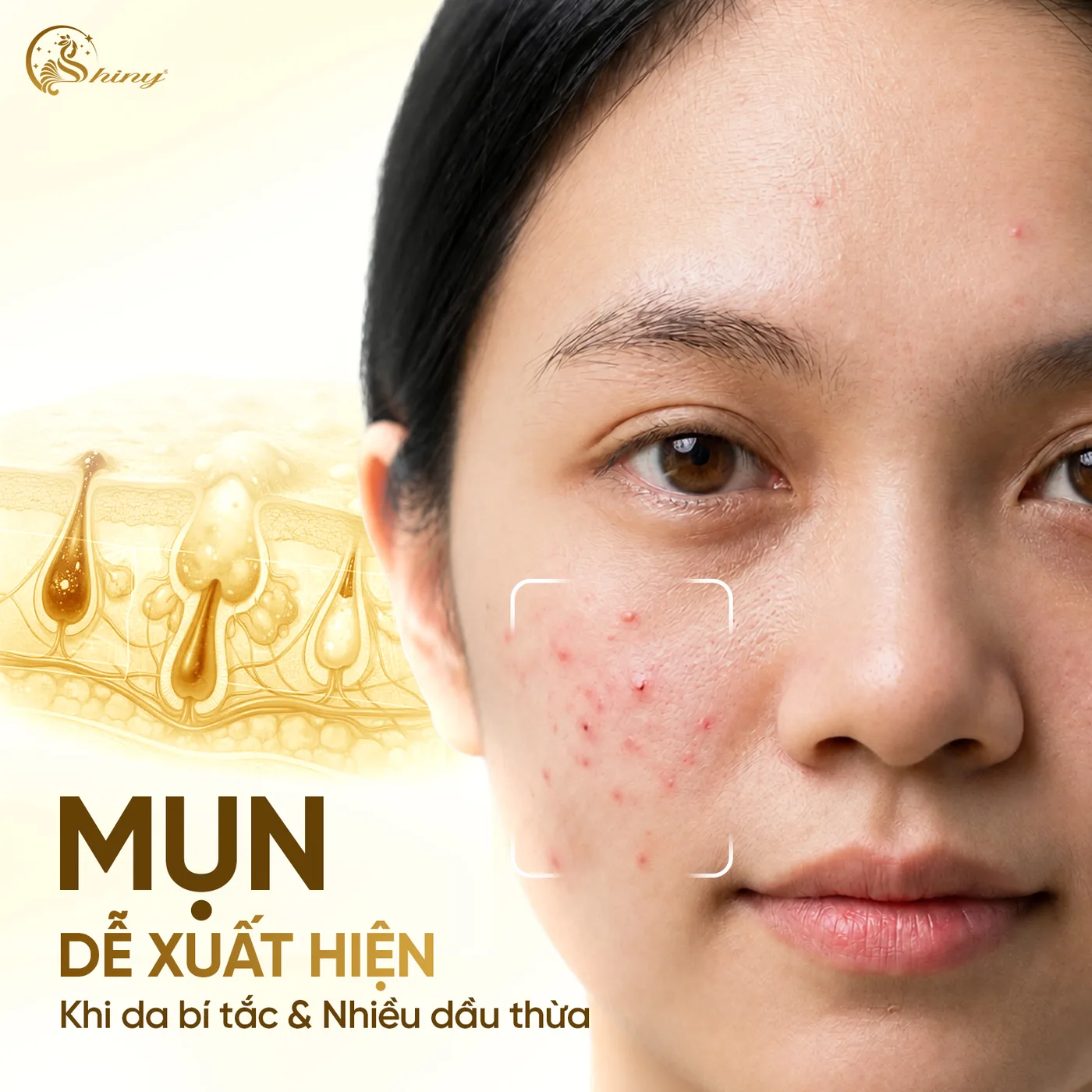 Mụn dễ xuất hiện khi da bị bí tắc và chăm da sóc không đúng cách