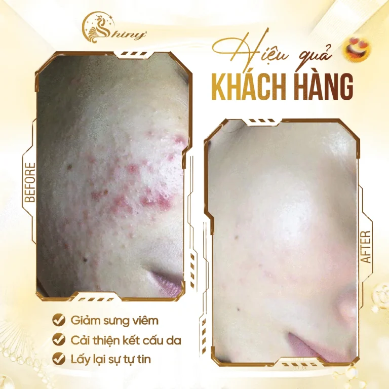 Thiết kế so sánh hai ảnh cận cảnh vùng má trong bộ hình của Shiny; không phải cam kết hiệu quả.