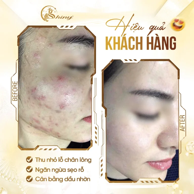 Thiết kế trước–sau về da mụn do Shiny cung cấp; không đại diện cho kết quả của mọi người.